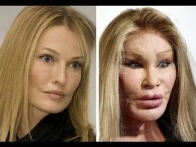 Знаменитые жертвы пластической хирургии: как искусственная красота разрушает жизни