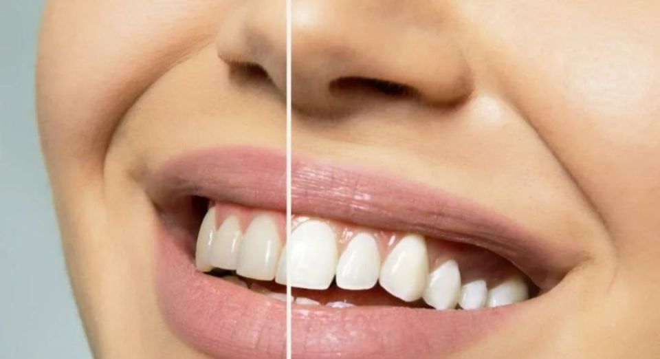 Современное отбеливание зубов: эффективный путь к белоснежной улыбке